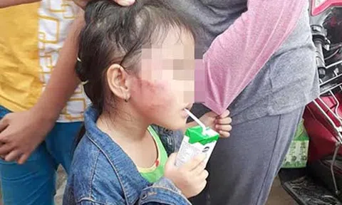 Vụ bé gái 5 tuổi bị tát tím mặt: Cô giáo đánh trẻ nói gì?